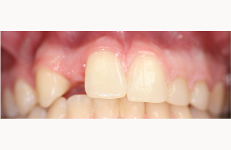 Before: Patient presents with a missing right lateral incisor, a 'baby' left lateral incisor, and a 'baby' left canine.  