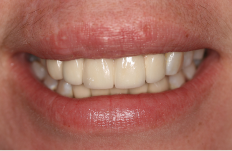 After: Patient treated with two bridges      supported by a total of six implants.  