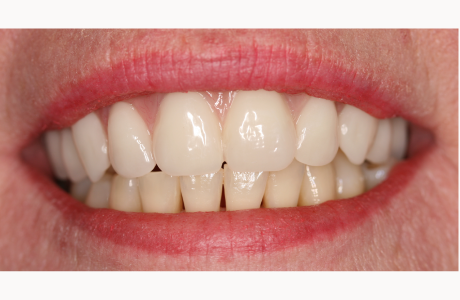 After: Patient treated with a fixed detachable prosthesis supported by five implants.  