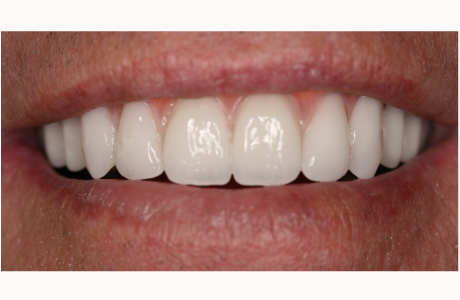 After: Patient photographed with definitive fixed detachable prostheses six months after surgery.  