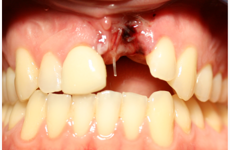 Before: Patient presents with old crown on right central incisor, recently extracted left central incisor, and short lateral incisor.  